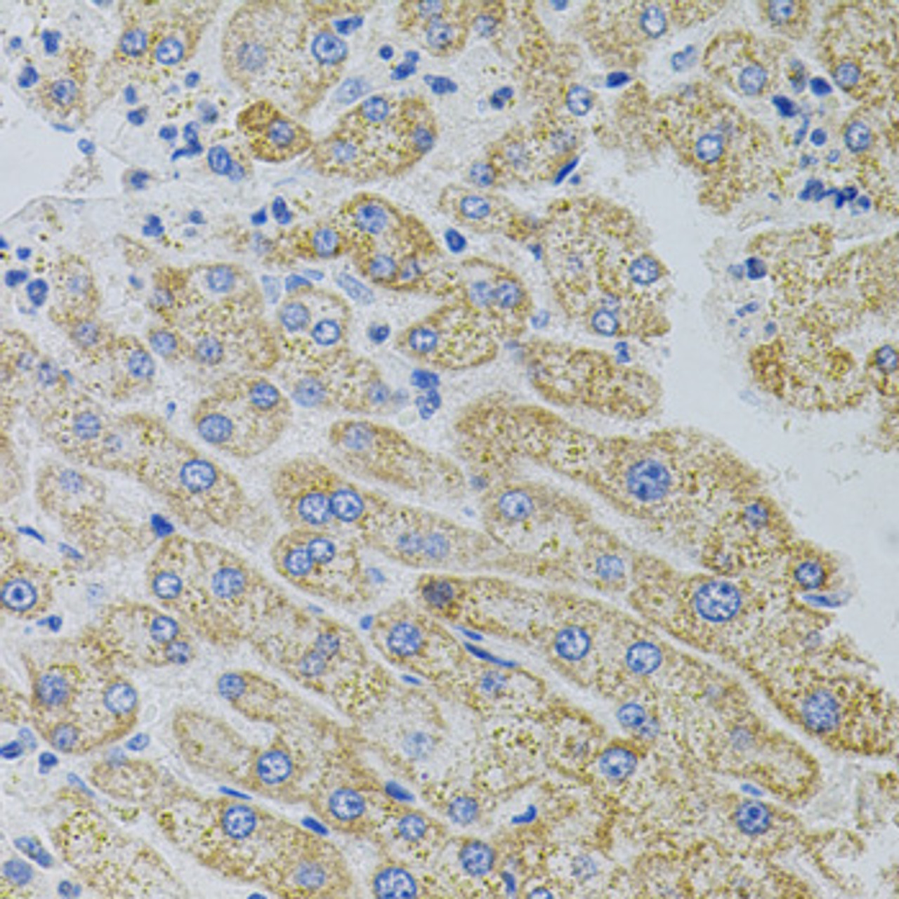 Immunohistochemistry of paraffin-embedded human liver damage using CRHR2 antibody (23-087) (40x lens) .