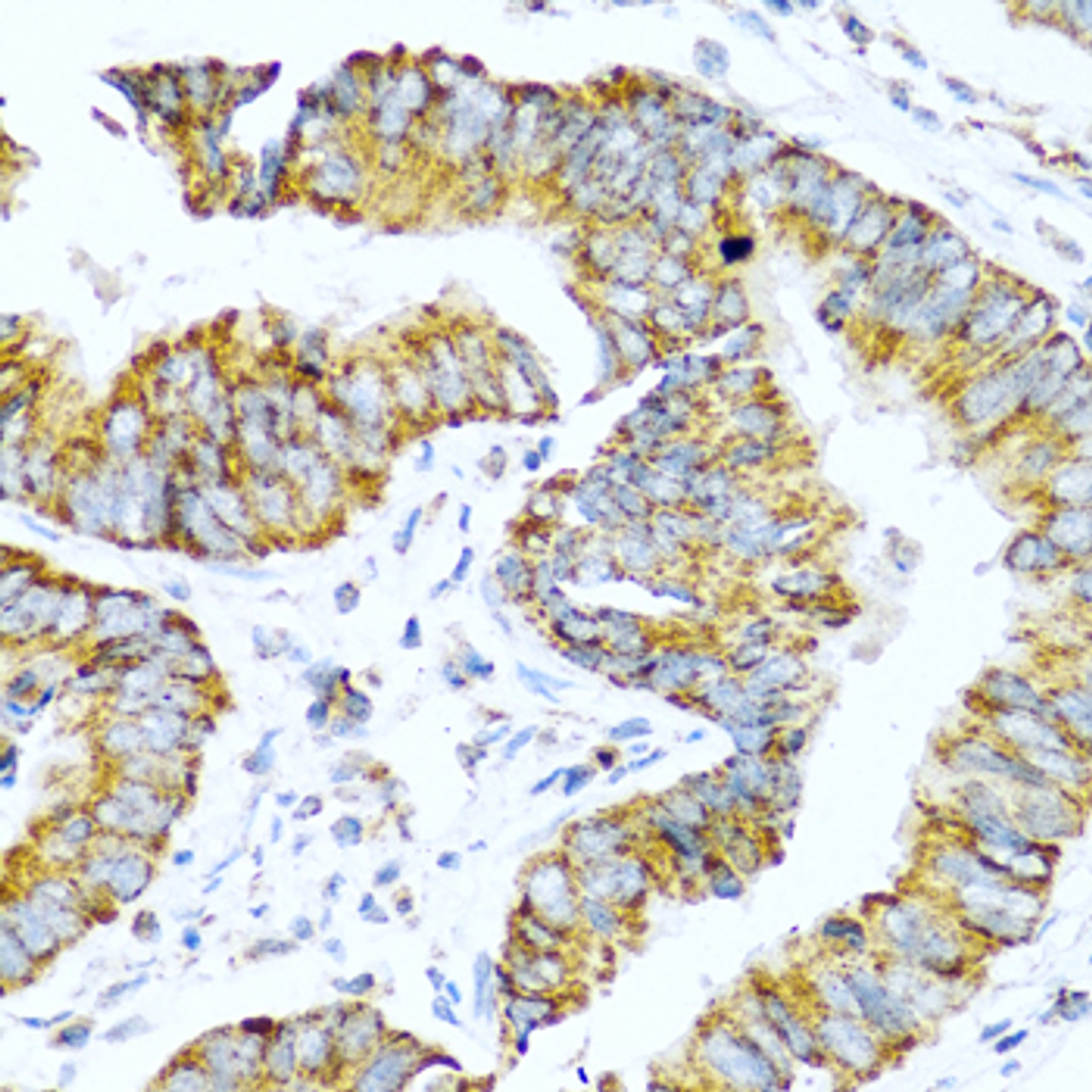 Immunohistochemistry of paraffin-embedded human colon carcinoma using GCG antibody (13-951) at dilution of 1:100 (40x lens) .
