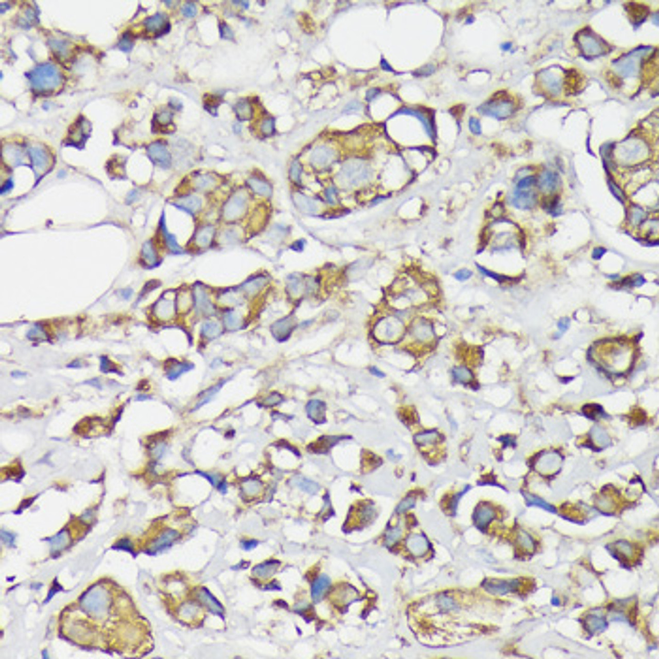 Immunohistochemistry of paraffin-embedded human breast cancer using KRT7 antibody (14-222) at dilution of 1:100 (40x lens) .