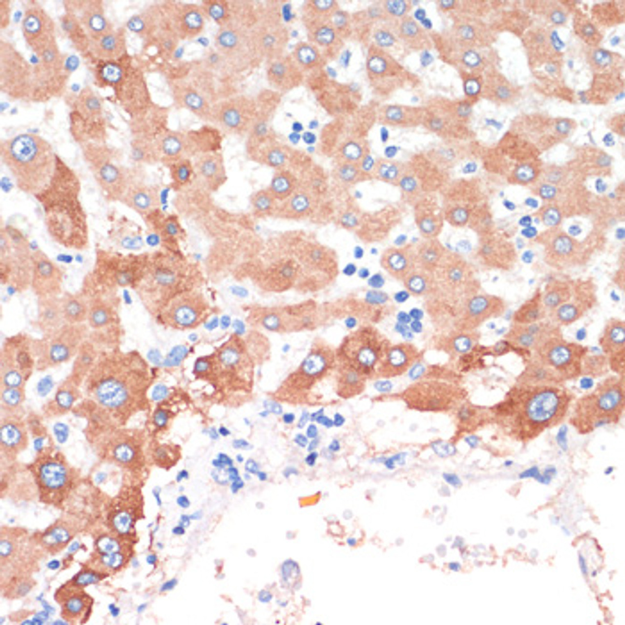 Immunohistochemistry of paraffin-embedded human liver cancer using CHAT antibody (14-412) at dilution of 1:200 (40x lens) .