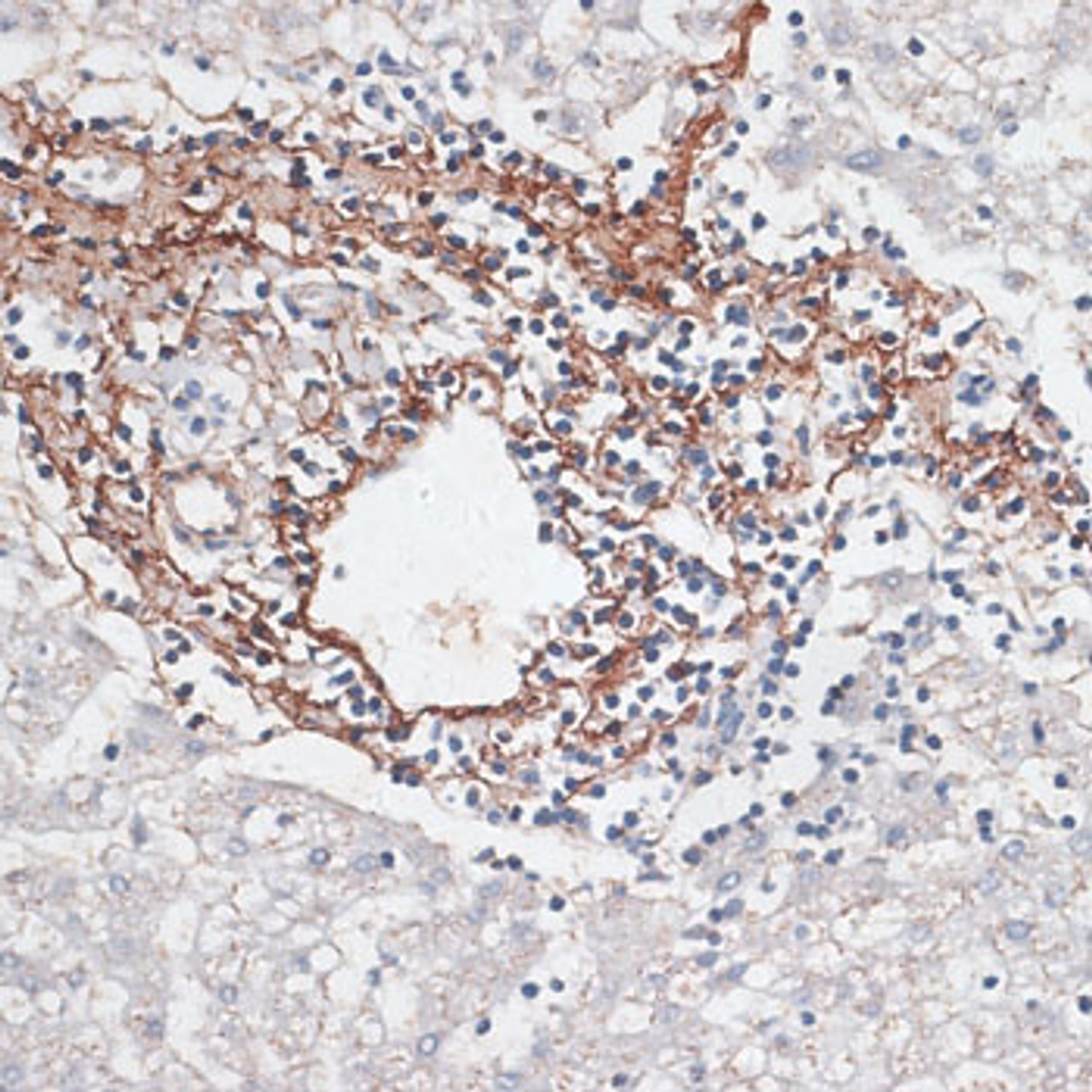 Immunohistochemistry of paraffin-embedded human liver cancer using ELN antibody (14-419) at dilution of 1:100 (40x lens) .