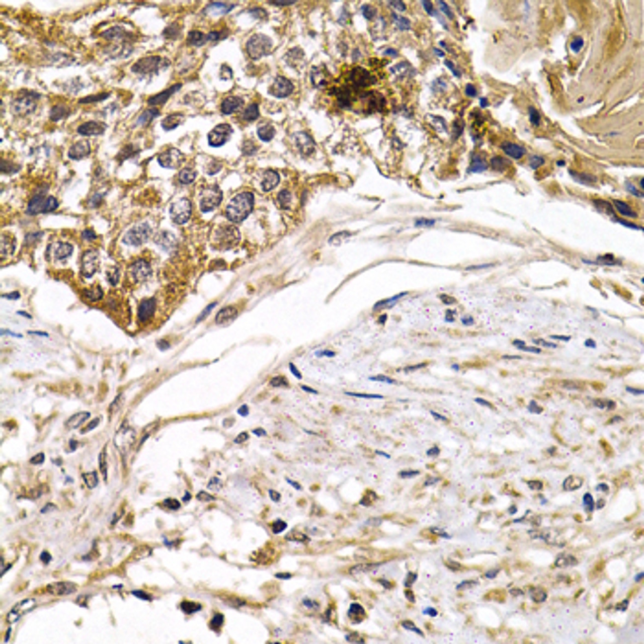 Immunohistochemistry of paraffin-embedded human breast cancer using ARRB2 antibody (14-883) at dilution of 1:200 (40x lens) .