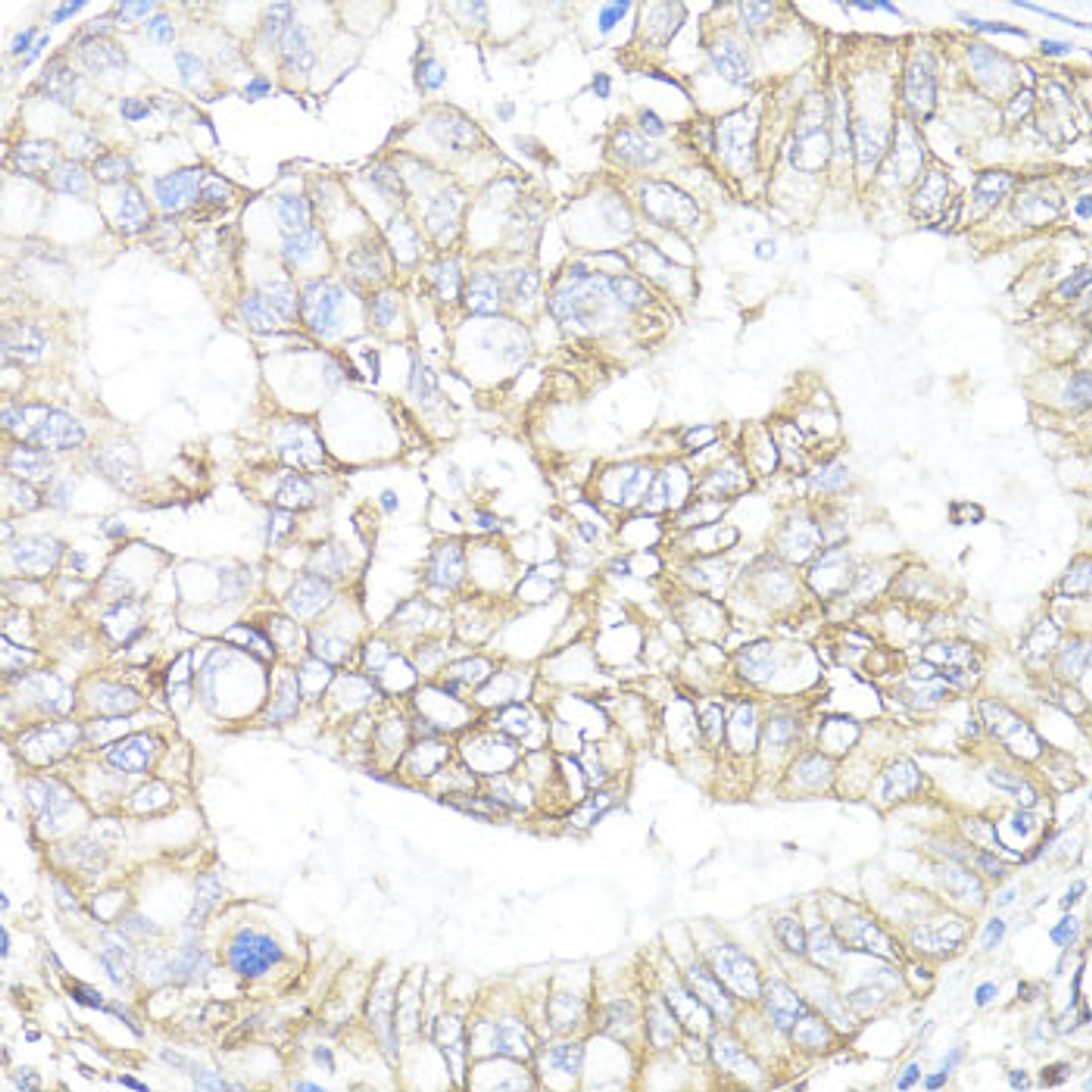 Immunohistochemistry of paraffin-embedded human lung cancer using ATP1B1 antibody (15-288) at dilution of 1:100 (40x lens) .
