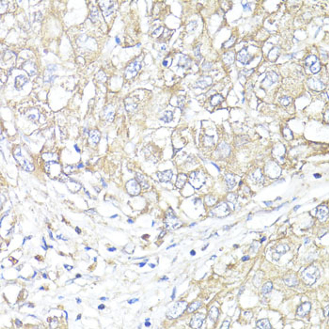 Immunohistochemistry of paraffin-embedded human liver cancer using ATP1B1 antibody (15-288) at dilution of 1:100 (40x lens) .