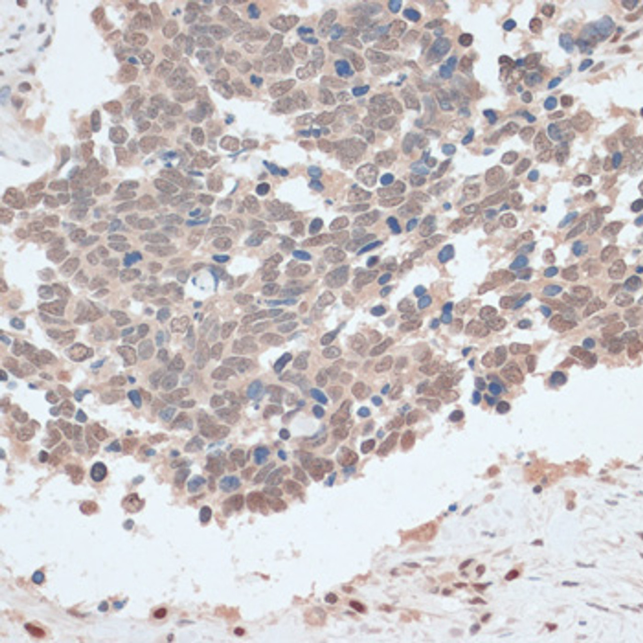Immunohistochemistry of paraffin-embedded human lung cancer using ZNF562 antibody (15-781) at dilution of 1:100 (40x lens) .