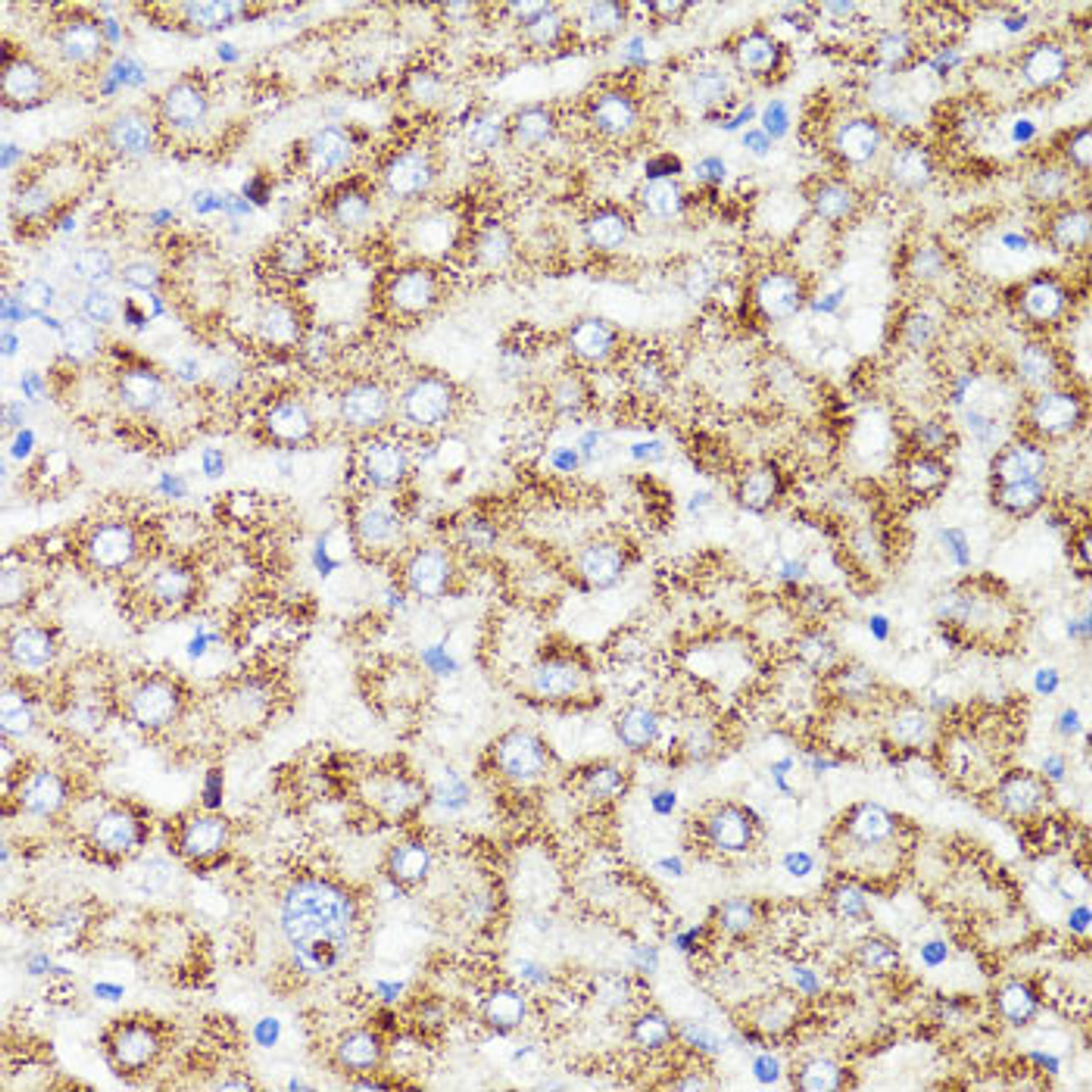 Immunohistochemistry of paraffin-embedded human liver cancer using PRR11 antibody (16-128) at dilution of 1:100 (40x lens) .