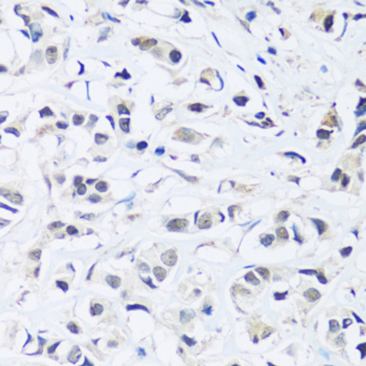 Immunohistochemistry of paraffin-embedded human breast cancer using ARL6IP4 antibody (16-875) at dilution of 1:100 (40x lens) .
