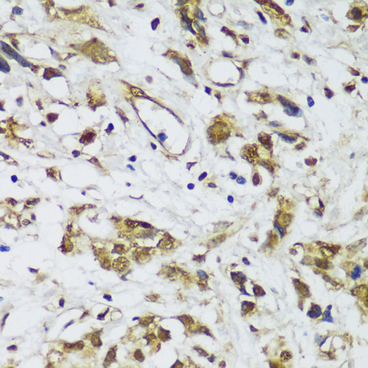 Immunohistochemistry of paraffin-embedded human gastric cancer using DPY30 antibody (18-103) at dilution of 1:150 (40x lens) .