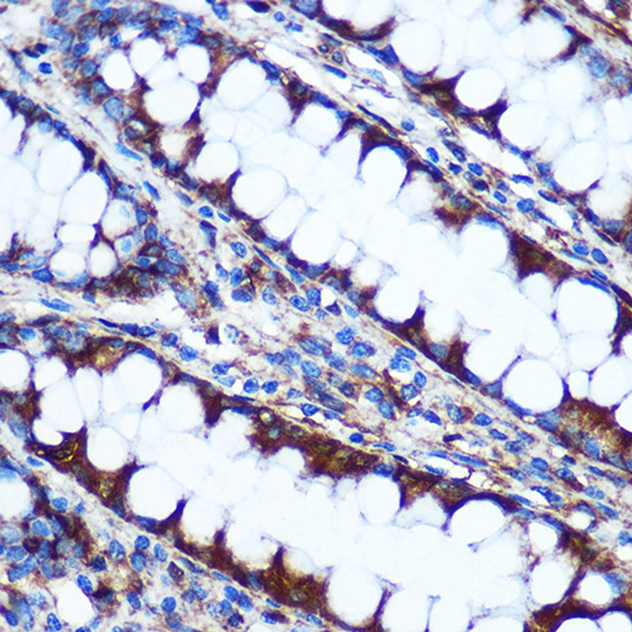 Immunohistochemistry of paraffin-embedded Human colon using HILPDA antibody (18-322) at dilution of 1:100 (40x lens) .