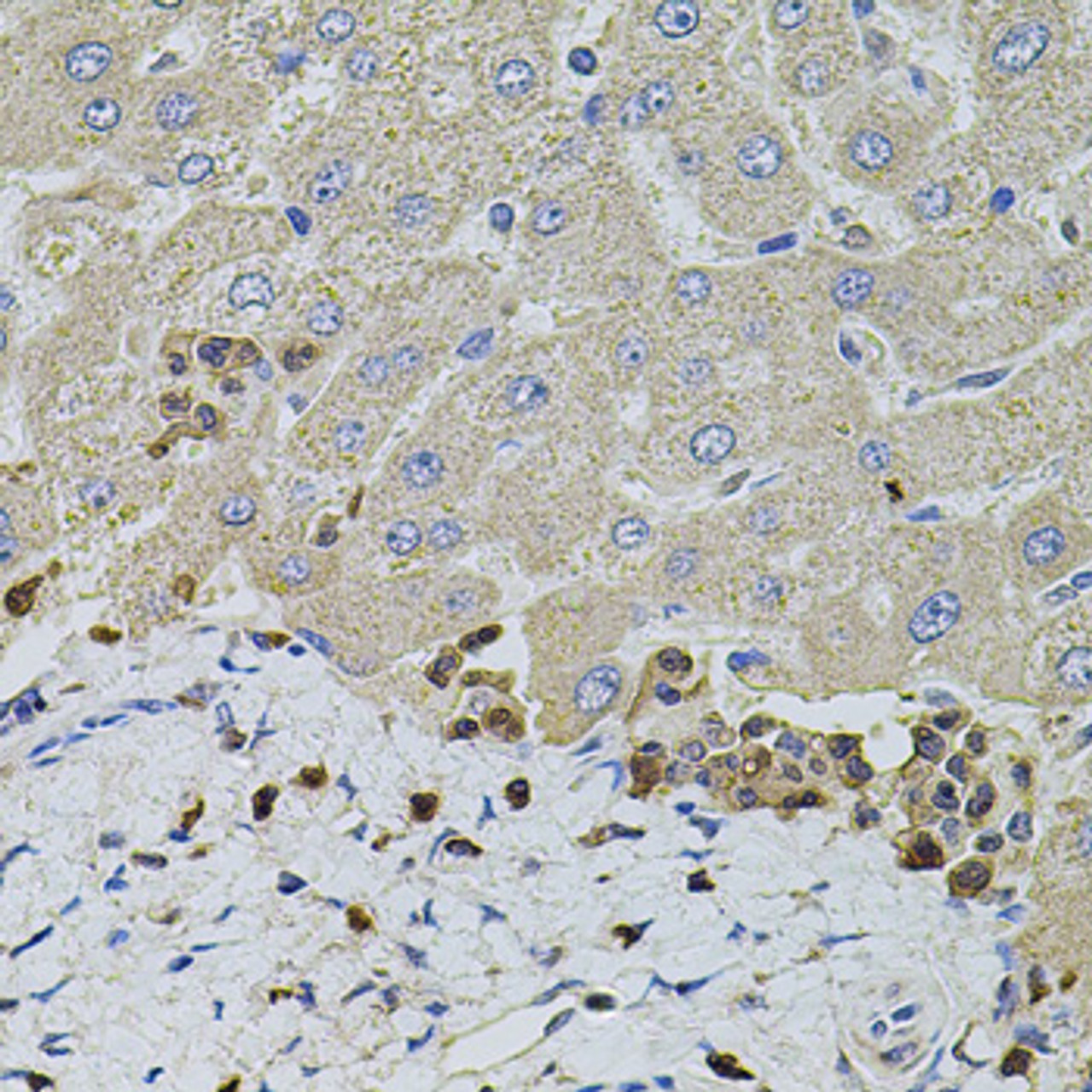 Immunohistochemistry of paraffin-embedded human liver damage using S100A12 antibody (19-592) at dilution of 1:100 (40x lens) .