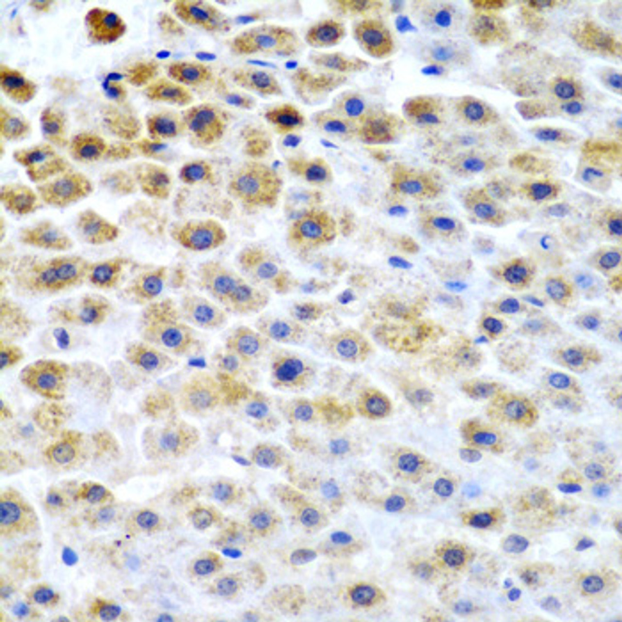 Immunohistochemistry of paraffin-embedded human liver cancer using TFPI2 antibody (22-056) at dilution of 1:200 (40x lens) .