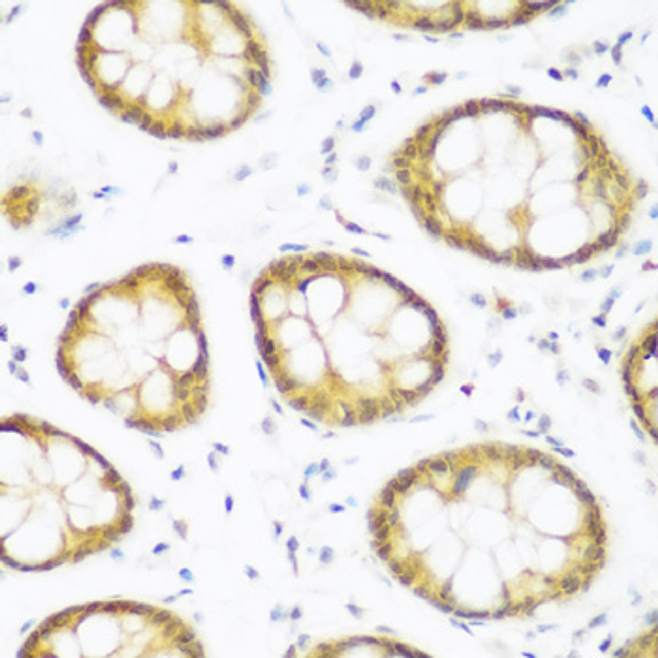 Immunohistochemistry of paraffin-embedded human colon using BRD9 antibody (22-728) at dilution of 1:200 (40x lens) .