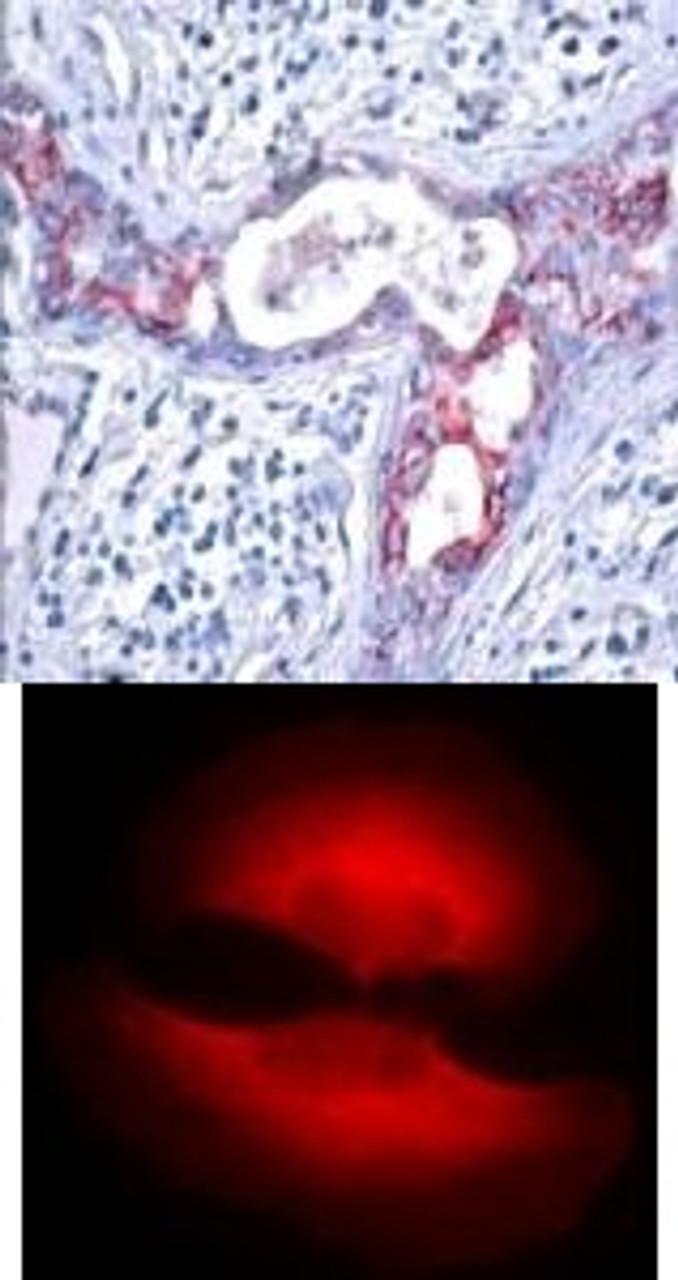 <b>Top Image:</b> Immunohistochemical analysis of paraffin-embedded human breast carcinoma tissue using GSK3&#946; (Phospho-Ser9) .<b>Bottom Image:</b> Immunofluorescence staining of methanol-fixed HeLa cells showing cytoplasmic staining using GSK3&#946; (Phospho-Ser9) .