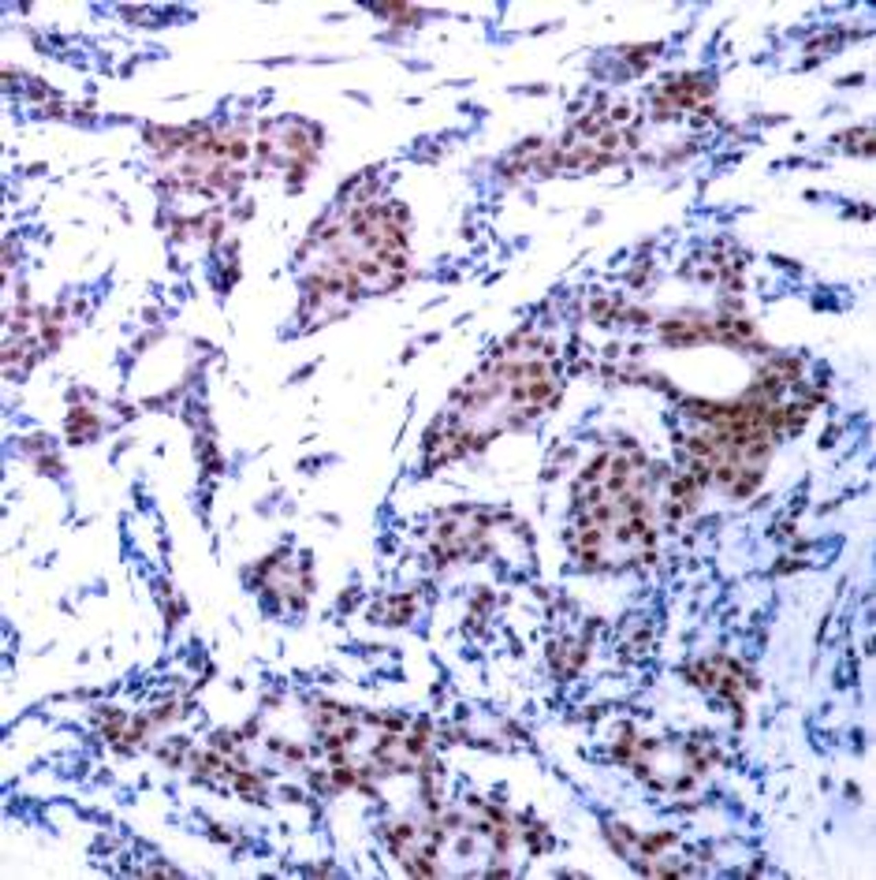 Immunohistochemical analysis of paraffin-embedded human breast carcinoma tissue using c-Jun (Phospho-Ser73) .