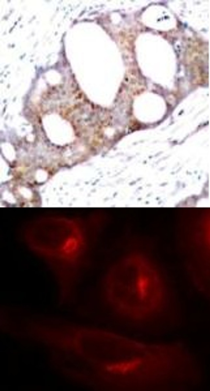 <b>Top Image:</b> Immunohistochemical analysis of paraffin-embedded human breast carcinoma tissue using GSK3&#945; (Phospho-Ser21) .<b>Bottom Image:</b> Immunofluorescence staining of methanol-fixed HeLa cells showing cytoplasmic staining using GSK3&#945; (Phospho-Ser21) .