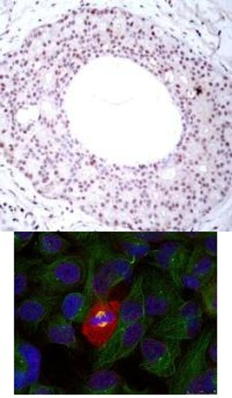 <b>Top Image:</b> Immunohistochemical analysis of paraffin-embedded human breast carcinoma tissue using NF&#954;B-p65 (Phospho-Thr254) .<b>Bottom Image:</b> Immunofluorescence staining of methanol-fixed HeLa using NF&#954;B-p65 (Phospho-Thr254) .