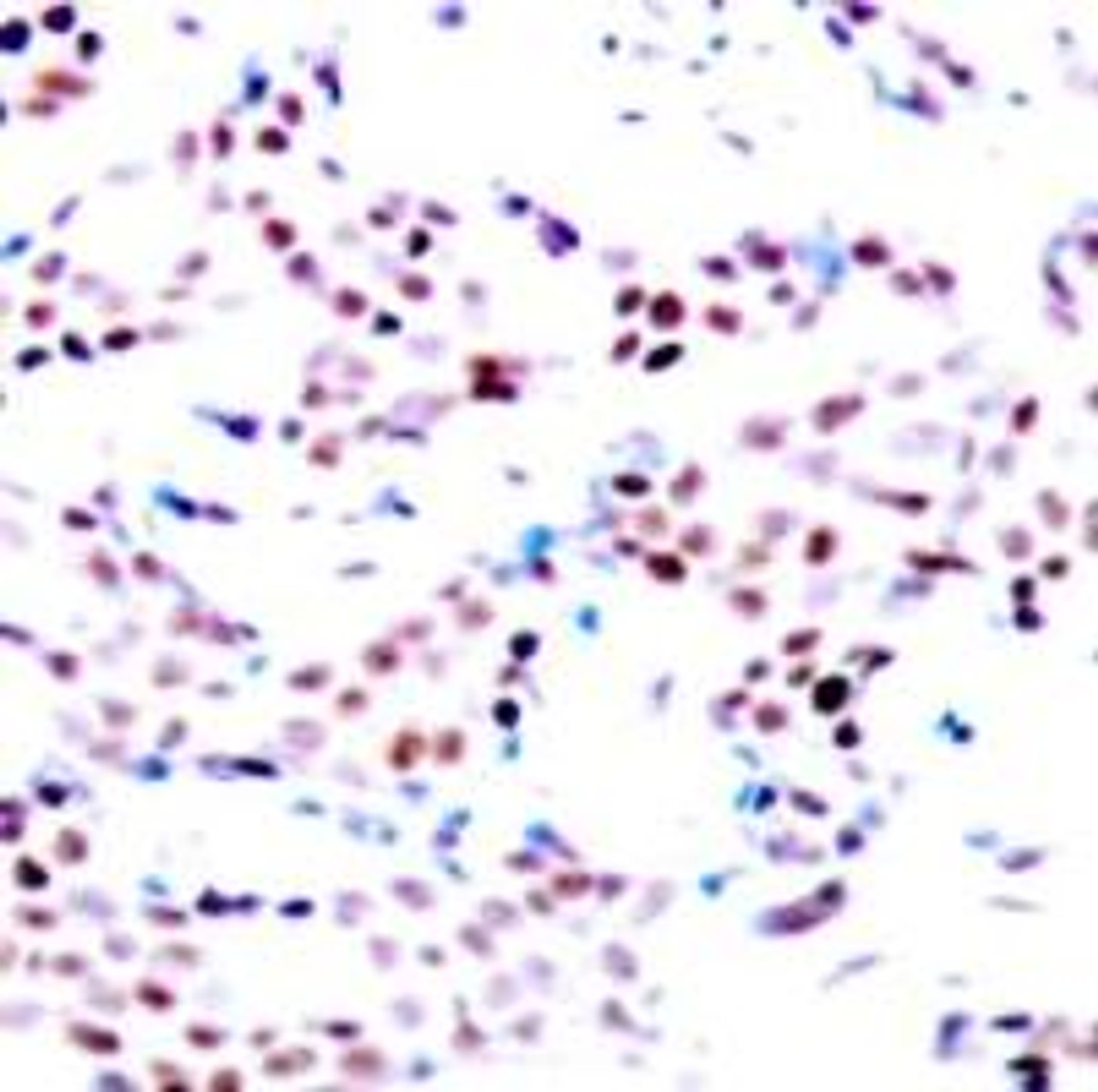Immunohistochemical analysis of paraffin-embedded human breast carcinoma tissue using c-Jun (Phospho-Thr91) .