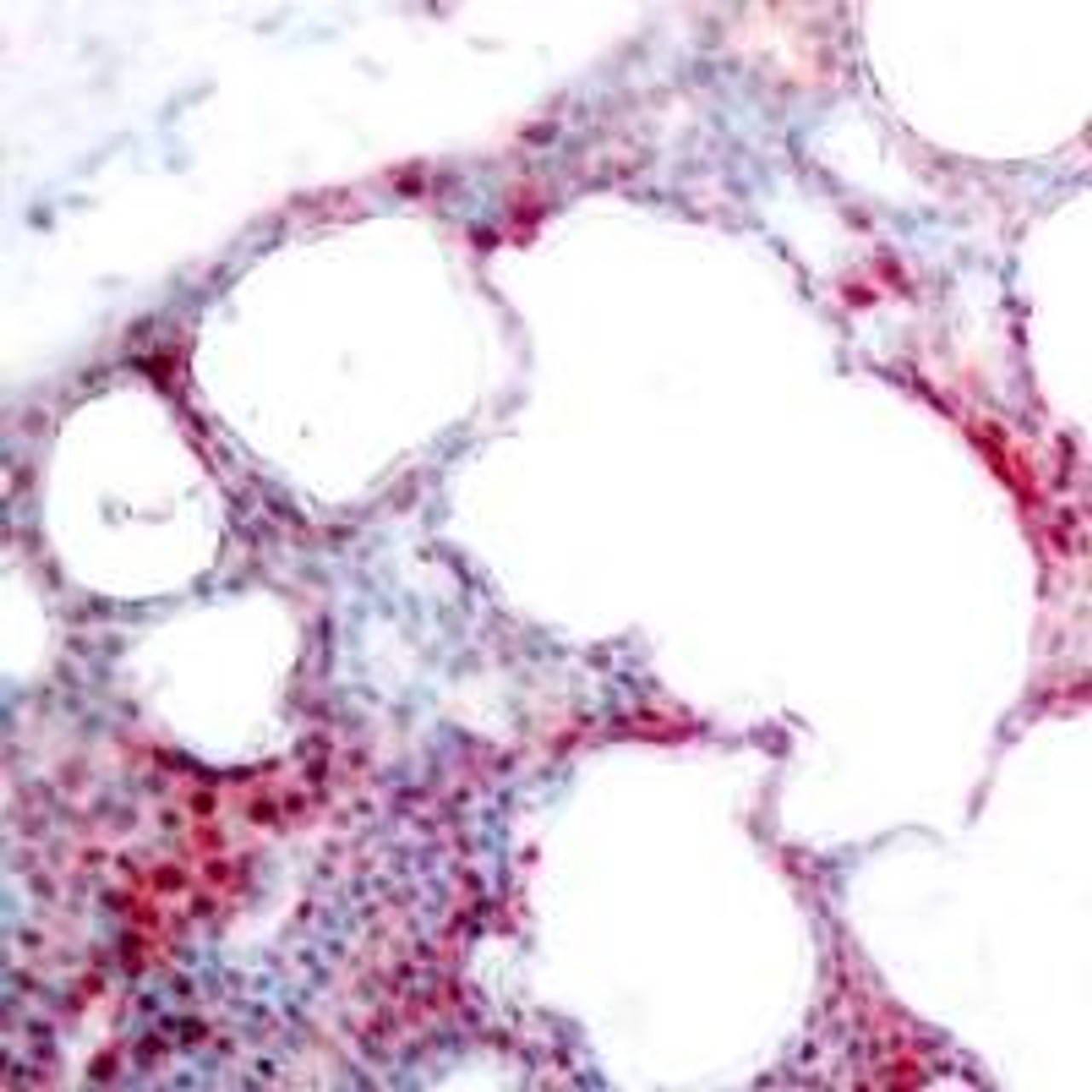 Immunohistochemical analysis of paraffin-embedded human breast carcinoma tissue using ATF2 (Phospho-Ser62 or 44) .