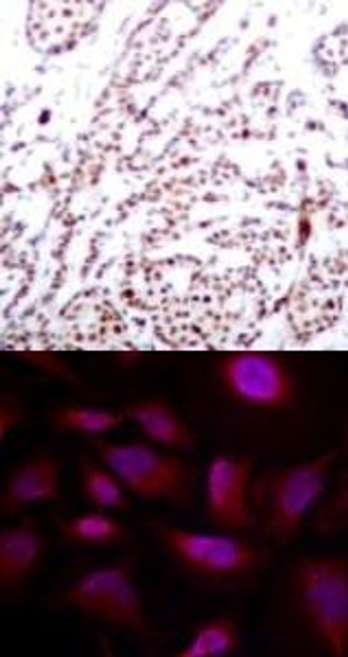<b>Top Image:</b> Immunohistochemical analysis of paraffin-embedded human breast carcinoma tissue using ATF2 (Phospho-Thr73 or 55) .<b>Bottom Image:</b> Immunofluorescence staining of methanol-fixed HeLa cells using ATF2 (Phospho-Thr73 or 55) .