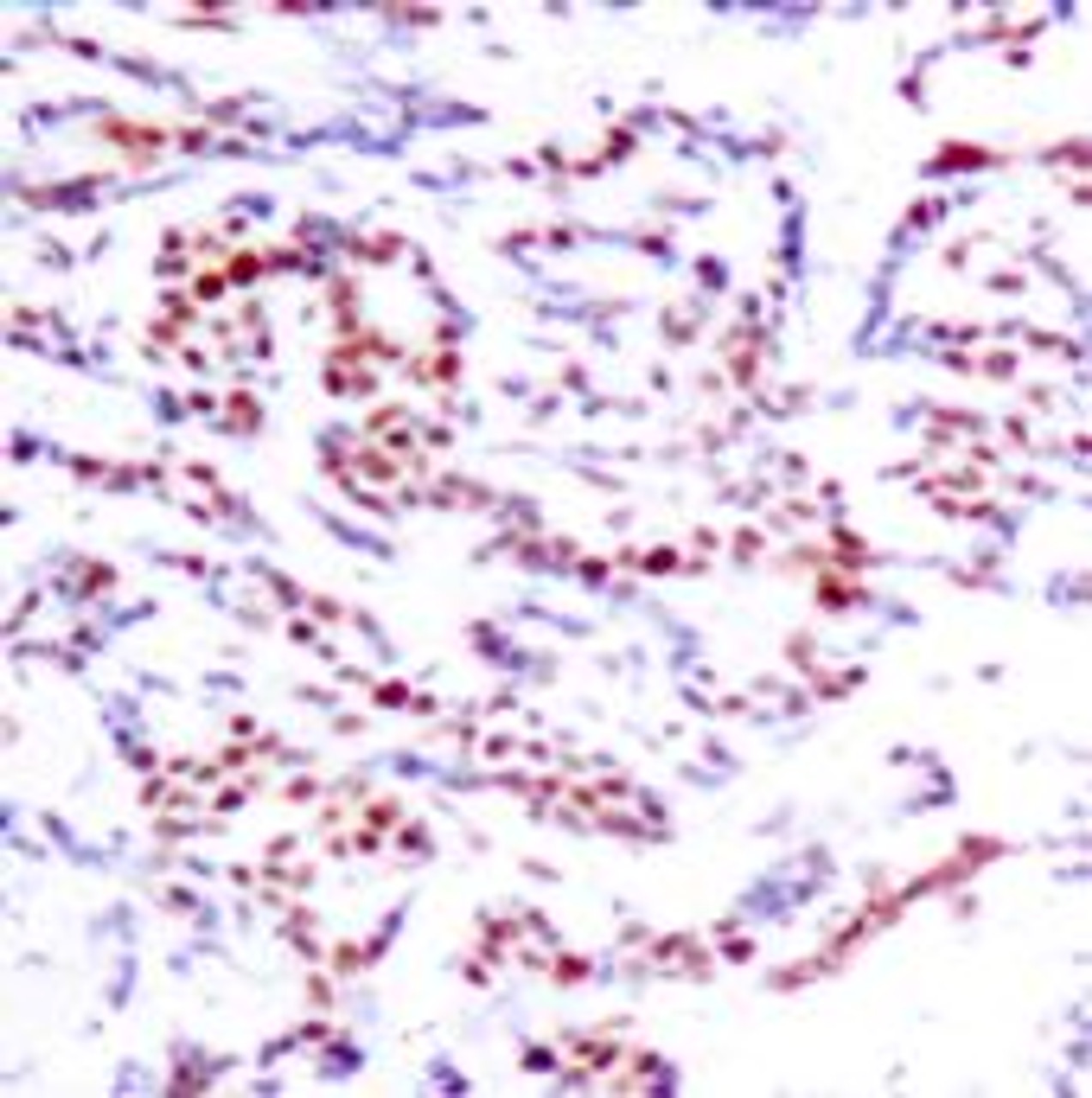 Immunohistochemical analysis of paraffin-embedded human breast carcinoma tissue using ATF2 (Phospho-Ser112 or 94) .