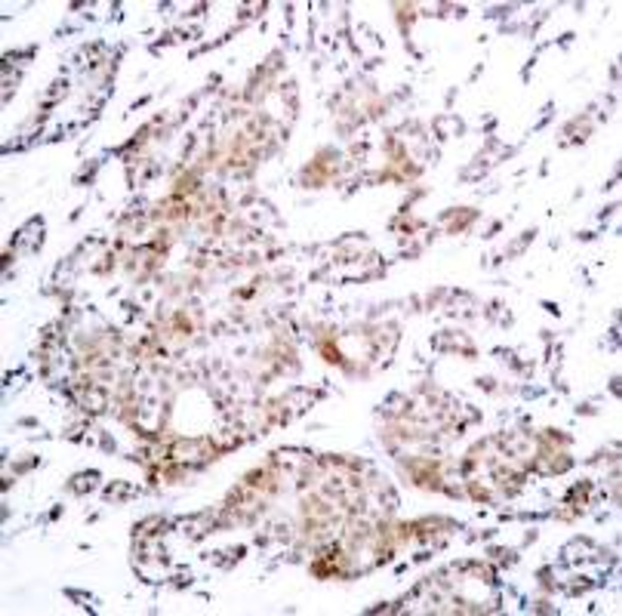 Immunohistochemical analysis of paraffin-embedded human breast carcinoma tissue using Myc (Phospho-Thr58) .