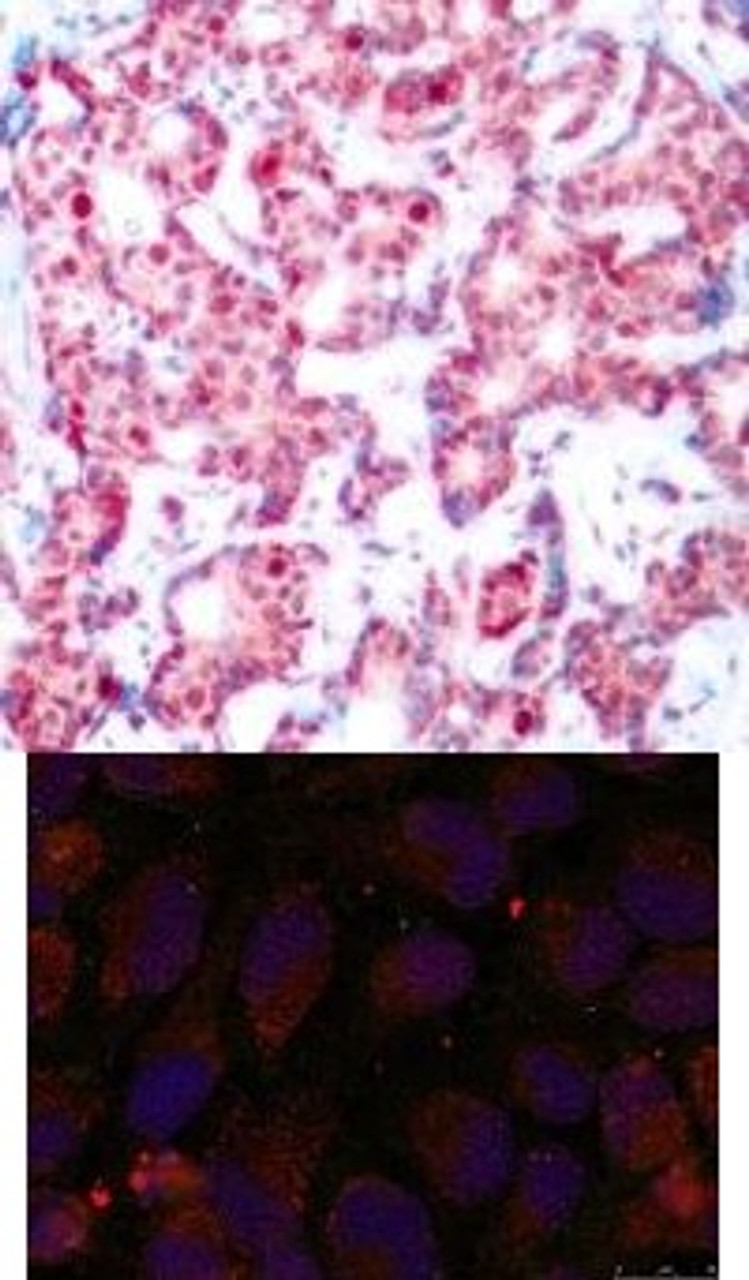 <b>Top Image:</b> Immunohistochemical analysis of paraffin-embedded human breast carcinoma tissue using GATA1 (Phospho-Ser142) .<b>Bottom Image:</b> Immunofluorescence staining of methanol-fixed HeLa cells using GATA1 (Phospho-Ser142) .