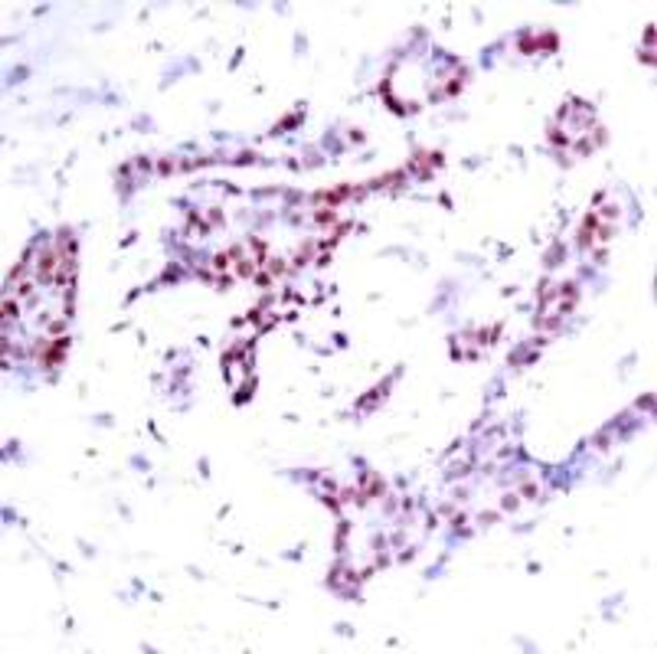 Immunohistochemical analysis of paraffin-embedded human breast carcinoma tissue using STAT1 (Phospho-Tyr701) .