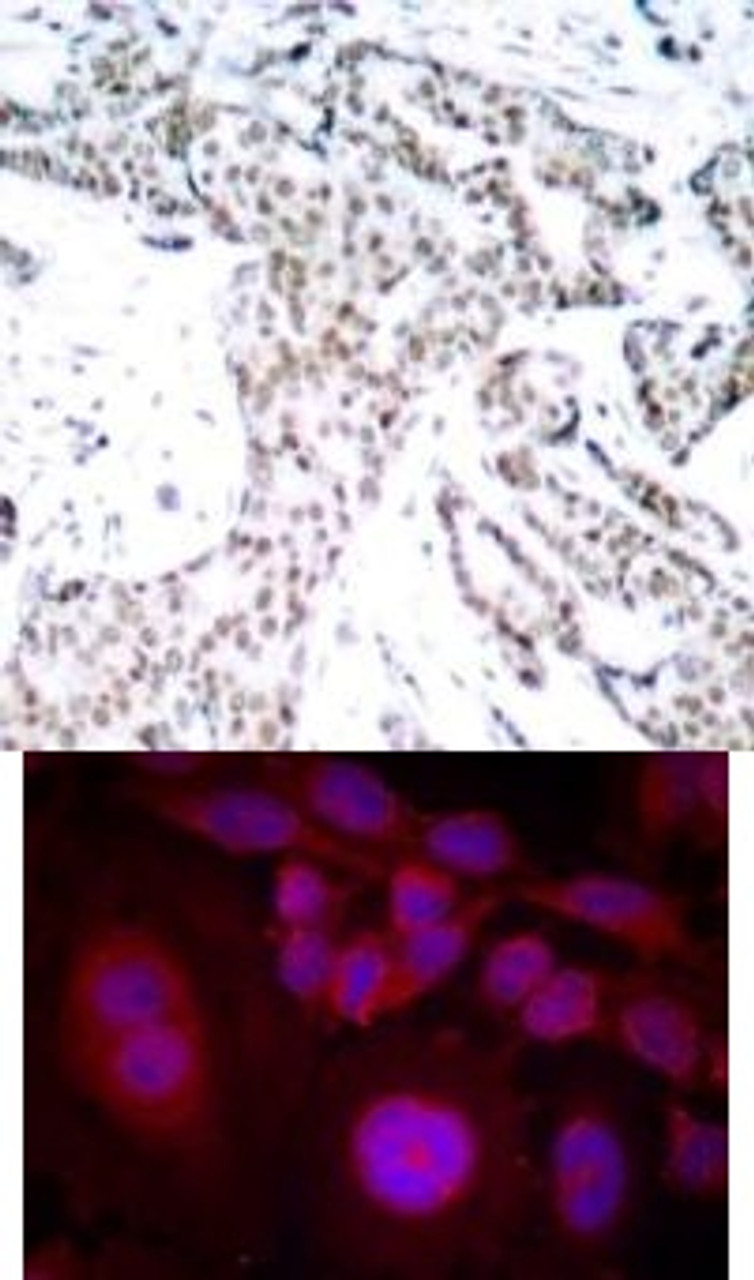 <b>Top Image:</b> Immunohistochemical analysis of paraffin-embedded human breast carcinoma tissue using STAT3 (Phospho-Ser727) .<b>Bottom Image:</b> Immunofluorescence staining of methanol-fixed HeLa cells using STAT3 (Phospho-Ser727) .