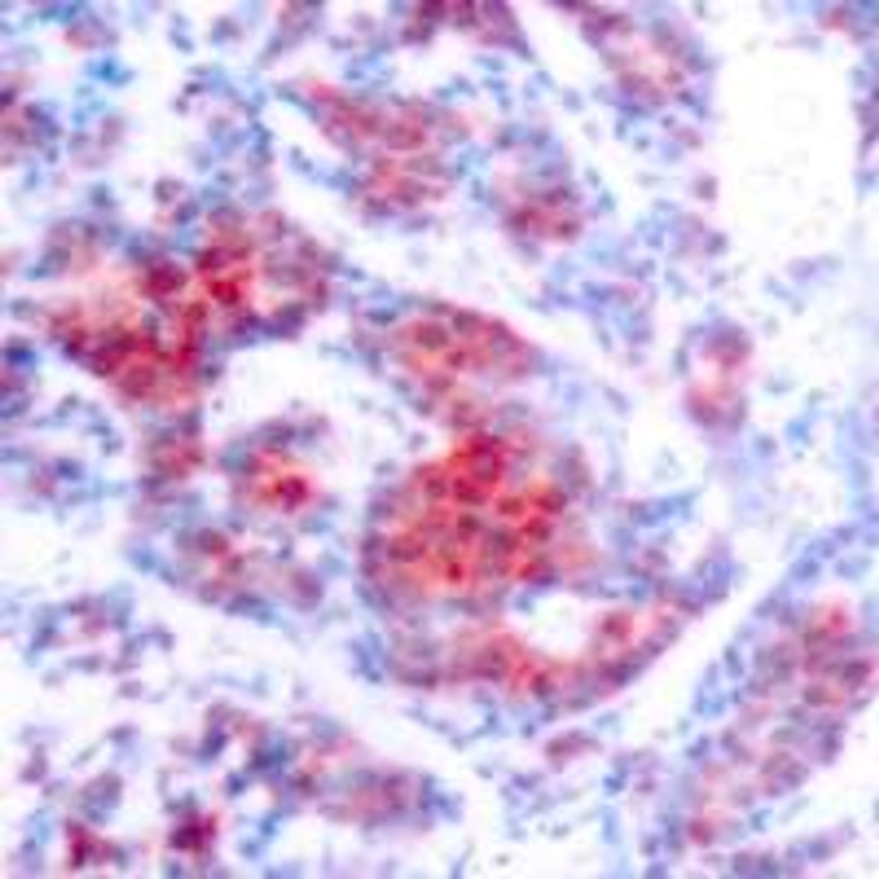 Immunohistochemical analysis of paraffin-embedded human breast carcinoma tissue using STAT4 (Phospho-Tyr693) .