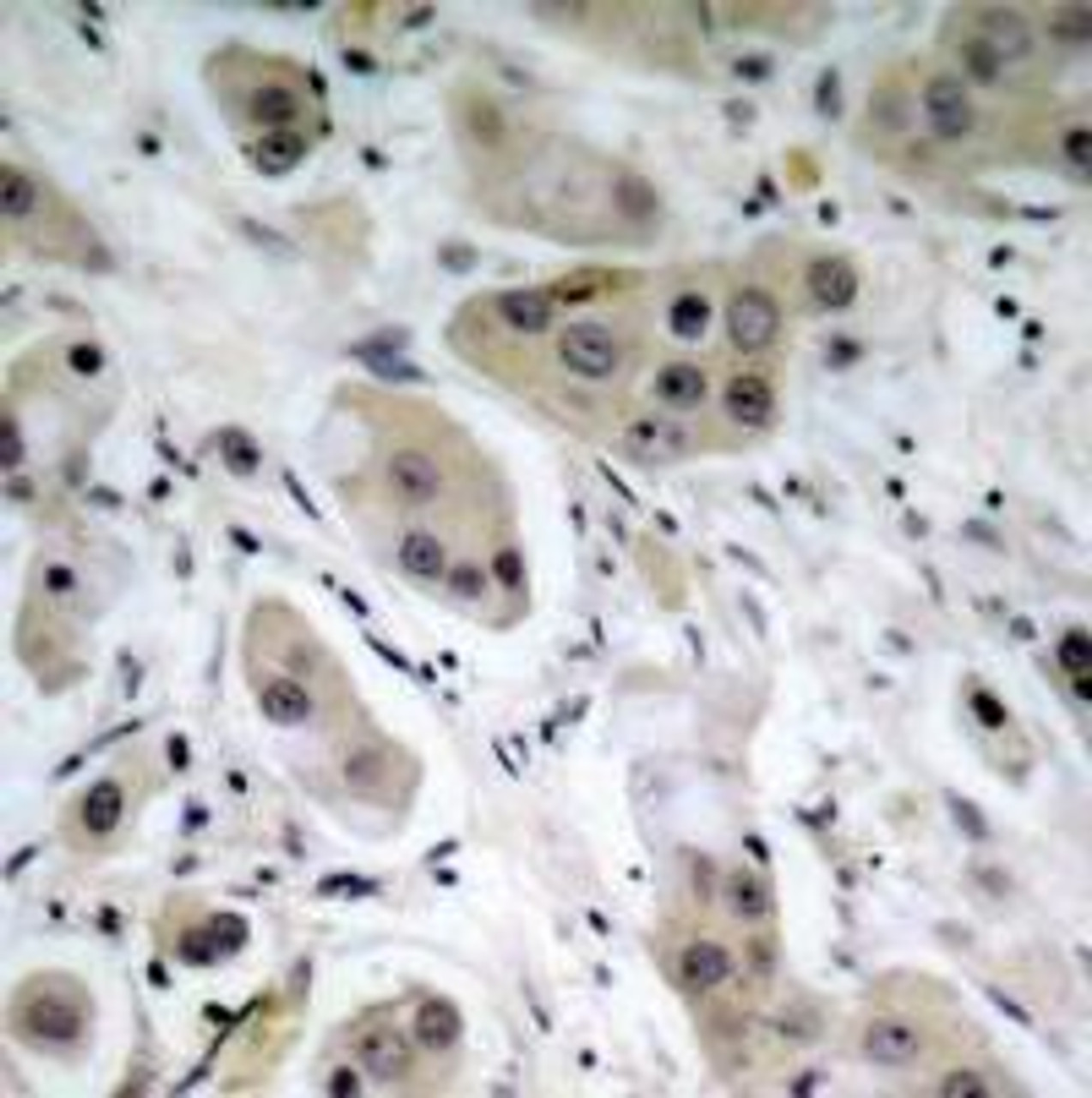 Immunohistochemical analysis of paraffin-embedded human breast carcinoma tissue using Akt (Phospho-Ser473) .