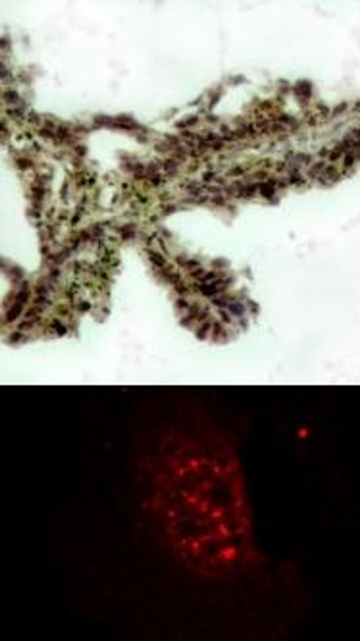 <b>Top Image:</b> Immunohistochemical analysis of paraffin-embedded human lung carcinoma tissue, using Akt (Phospho-Thr308) .<b>Bottom Image:</b> Immunofluorescence staining of methanol-fixed HeLa cells showing nuclear dot staining using Akt (Phospho-Thr308) .