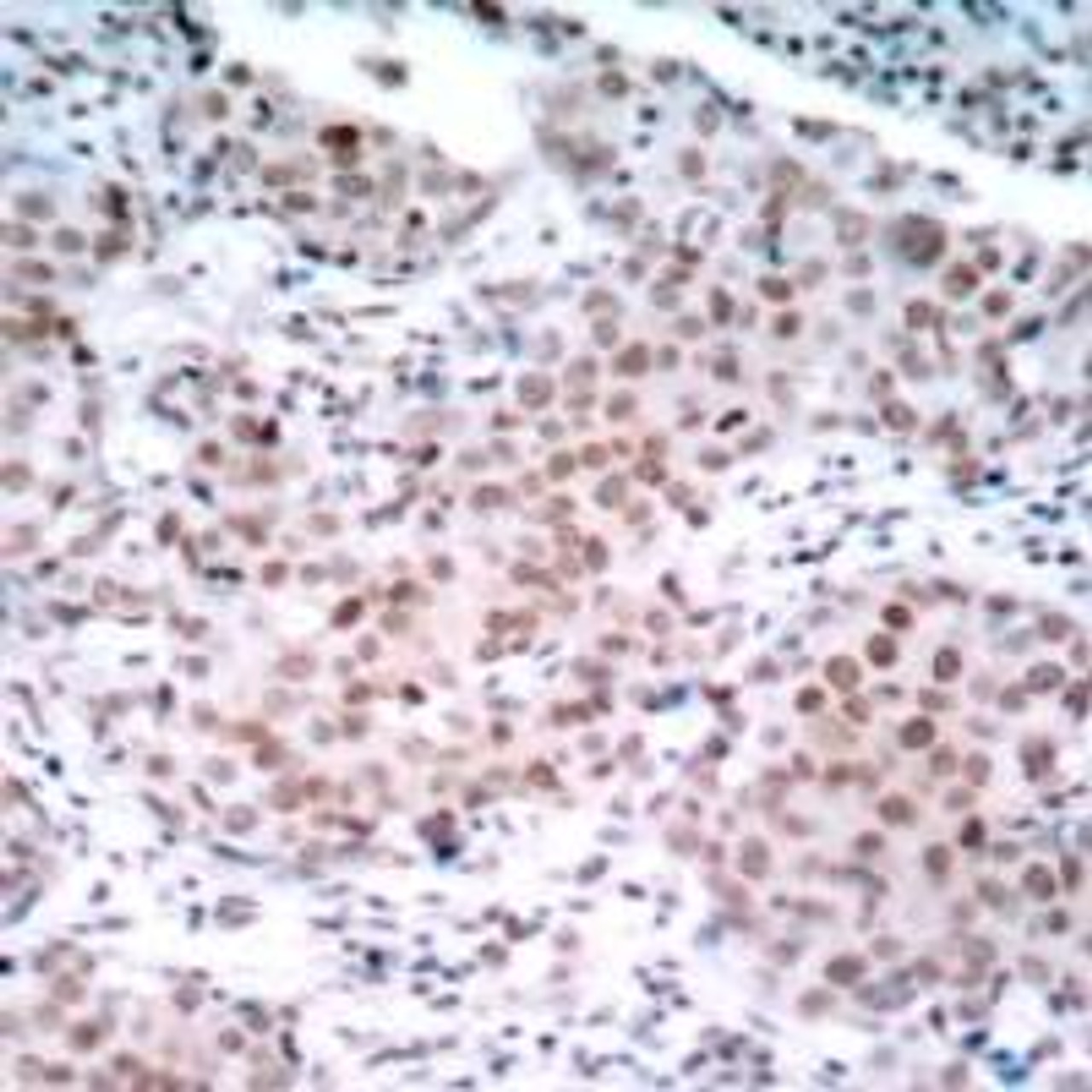 Immunohistochemical analysis of paraffin-embedded human breast carcinoma tissue using Estrogen Receptor-&#945; (Phospho-Ser104) .