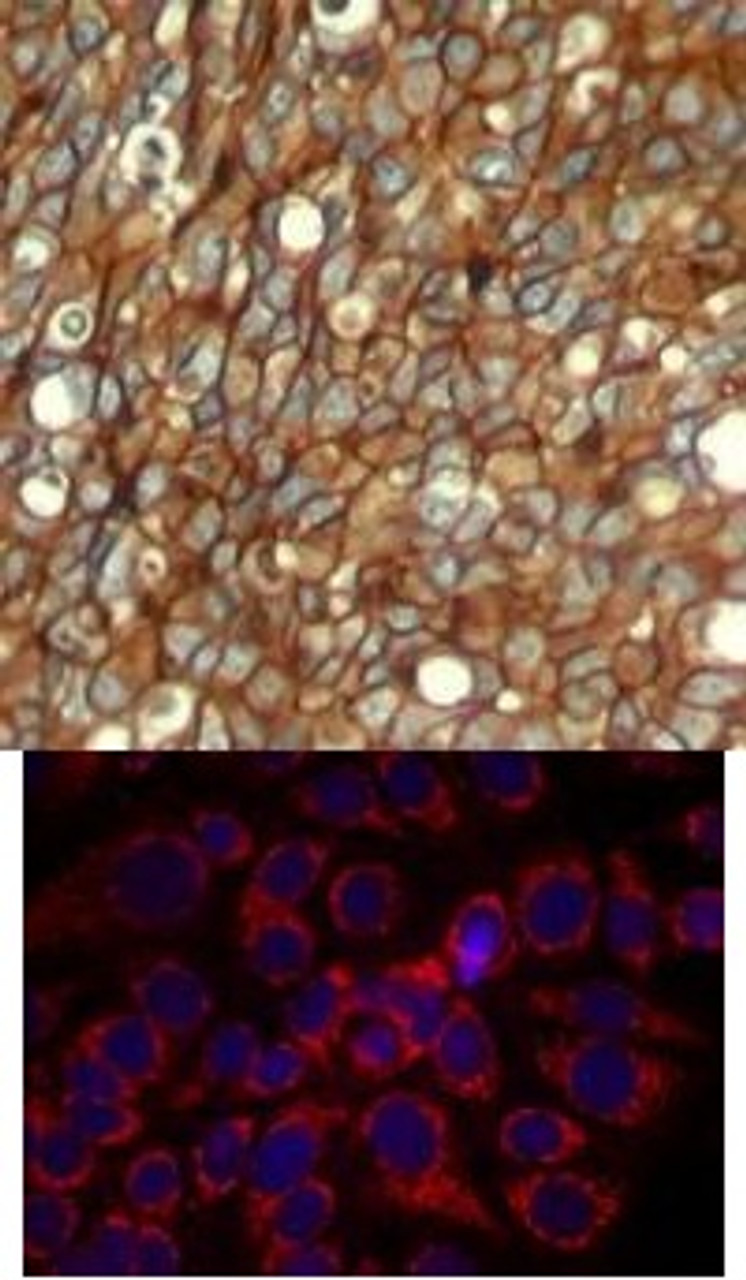<b>Top Image:</b> Immunohistochemical analysis of paraffin-embedded human breast carcinoma tissue using HER2 (Phospho-Tyr1248) .<b>Bottom Image:</b> Immunofluorescence staining of methanol-fixed MCF7 cells using HER2 (Phospho-Tyr1248) .