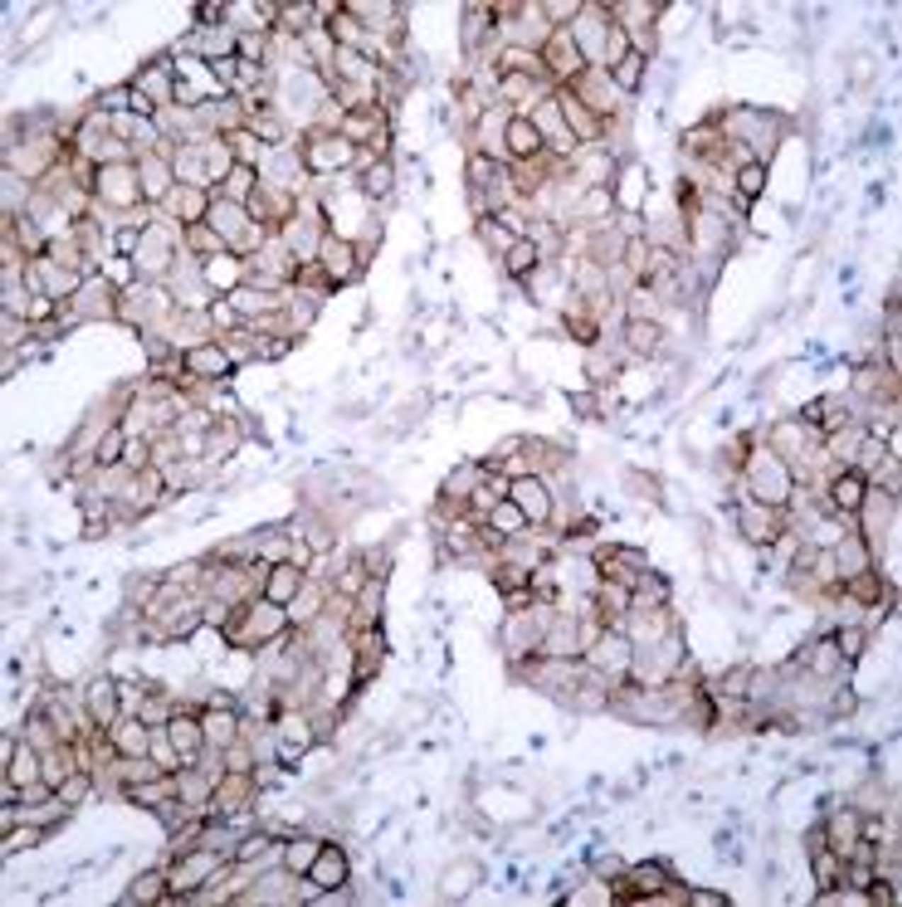 Immunohistochemical analysis of paraffin-embedded human breast carcinoma tissue using EGFR (Phospho-Tyr1092) .