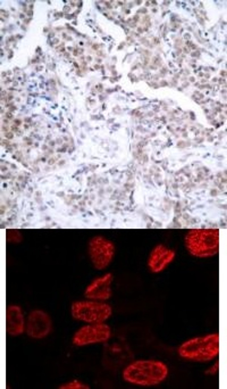 <b>Top Image:</b> Immunohistochemical analysis of paraffin-embedded human breast carcinoma tissue using p53 (Phospho-Ser15) .<b>Bottom Image:</b> Immunofluorescence staining of methanol-fixed HeLa cells using p53 (Phospho-Ser15) .