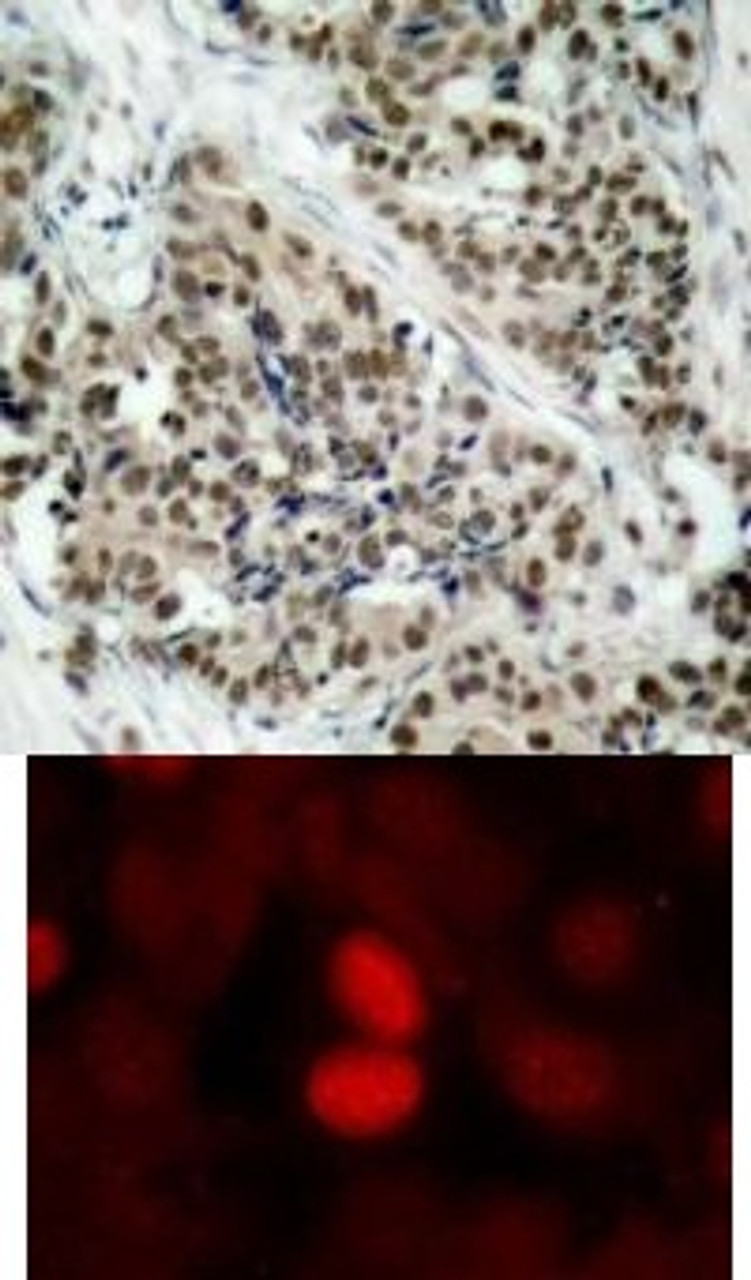 <b>Top Image:</b> Immunohistochemical analysis of paraffin- embedded human breast carcinoma tissue using FKHR (Phospho-Ser256) .<b>Bottom Image:</b> Immunofluorescence staining of methanol-fixed MCF7 cells using FKHR (Phospho-Ser256) .