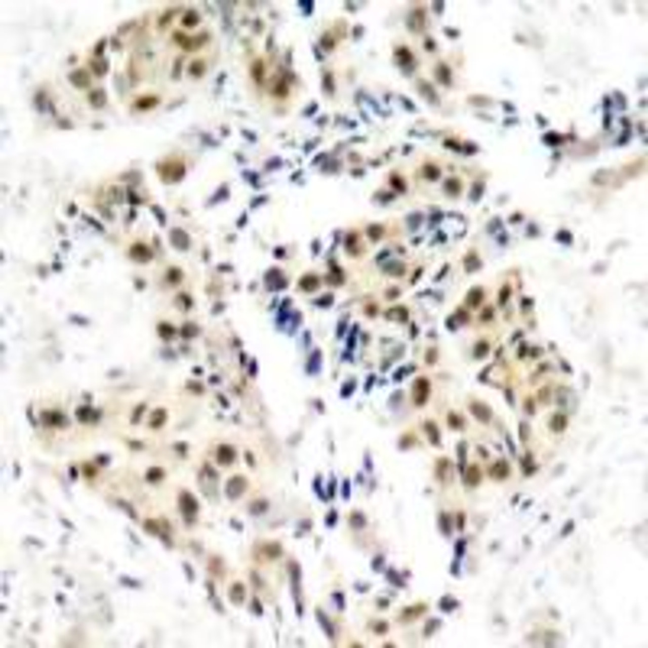 Immunohistochemical analysis of paraffin-embedded human breast carcinoma tissue using ATM (Phospho-Ser1981) .