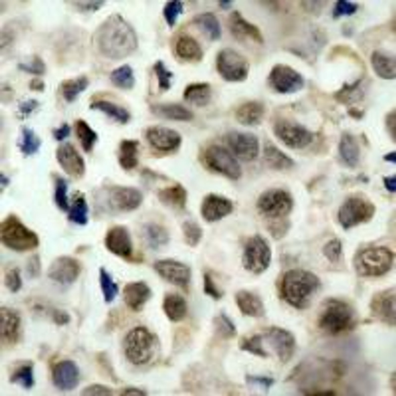 Immunohistochemical analysis of paraffin-embedded human lung carcinoma tissue using HDAC8 (Phospho-Ser39) .