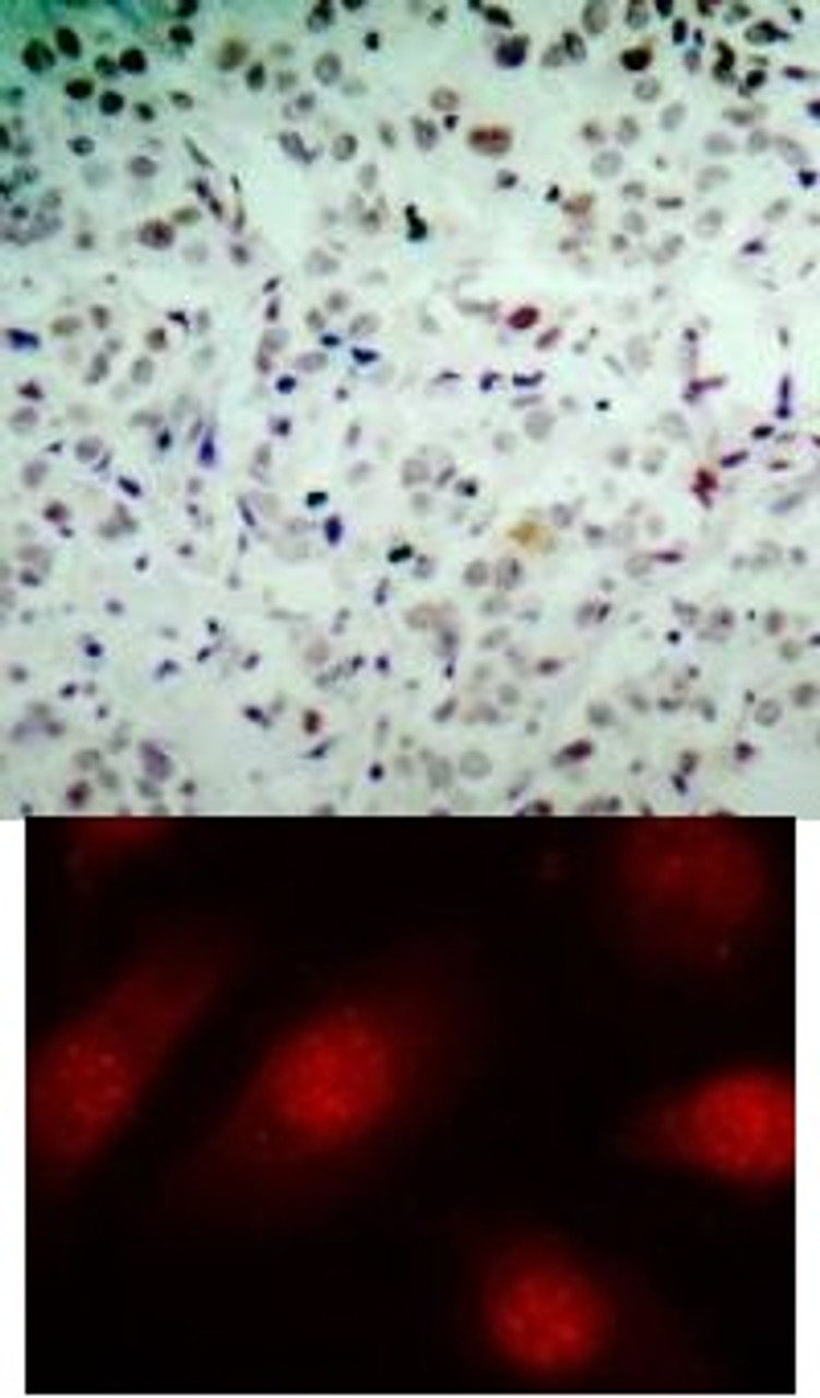 <b>Top Image:</b> Immunohistochemical analysis of paraffin-embedded human breast carcinoma tissue using Rb (Phospho-Ser780) .<b>Bottom Image:</b> Immunofluorescence staining of methanol-fixed HeLa cells using Rb (Phospho-Ser780) .