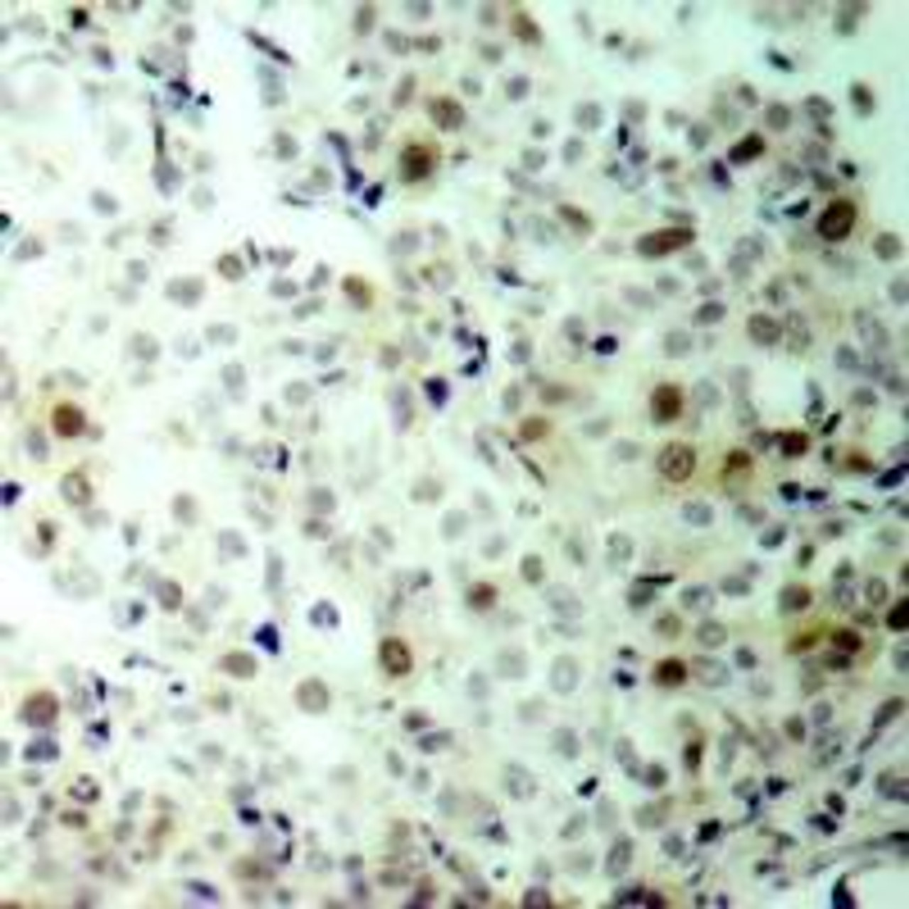 Immunohistochemical analysis of paraffin-embedded human breast carcinoma tissue using CDK2 (Phospho-Thr160) .