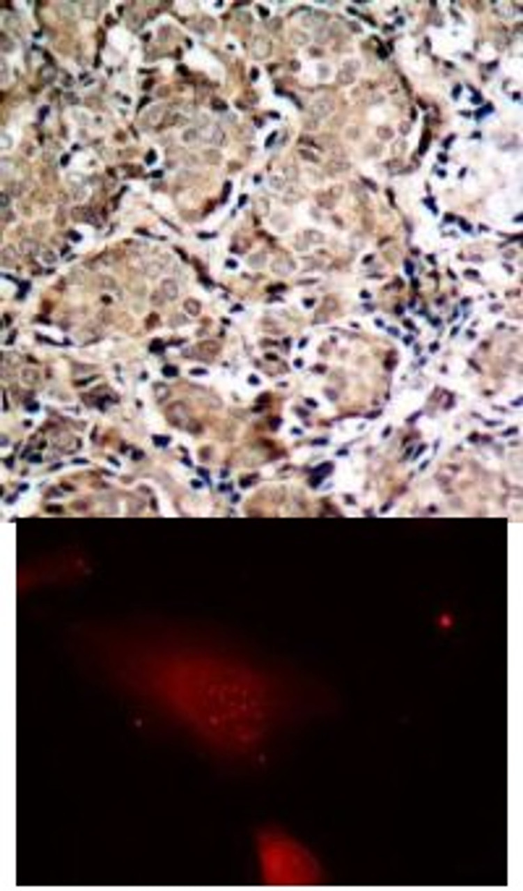 <b>Top Image:</b> Immunohistochemical analysis of paraffin-embedded human breast carcinoma tissue using FKHR (Phospho-Ser319) .<b>Bottom Image:</b> Immunofluorescence staining of methanol-fixed HeLa cells using FKHR (Phospho-Ser319) .