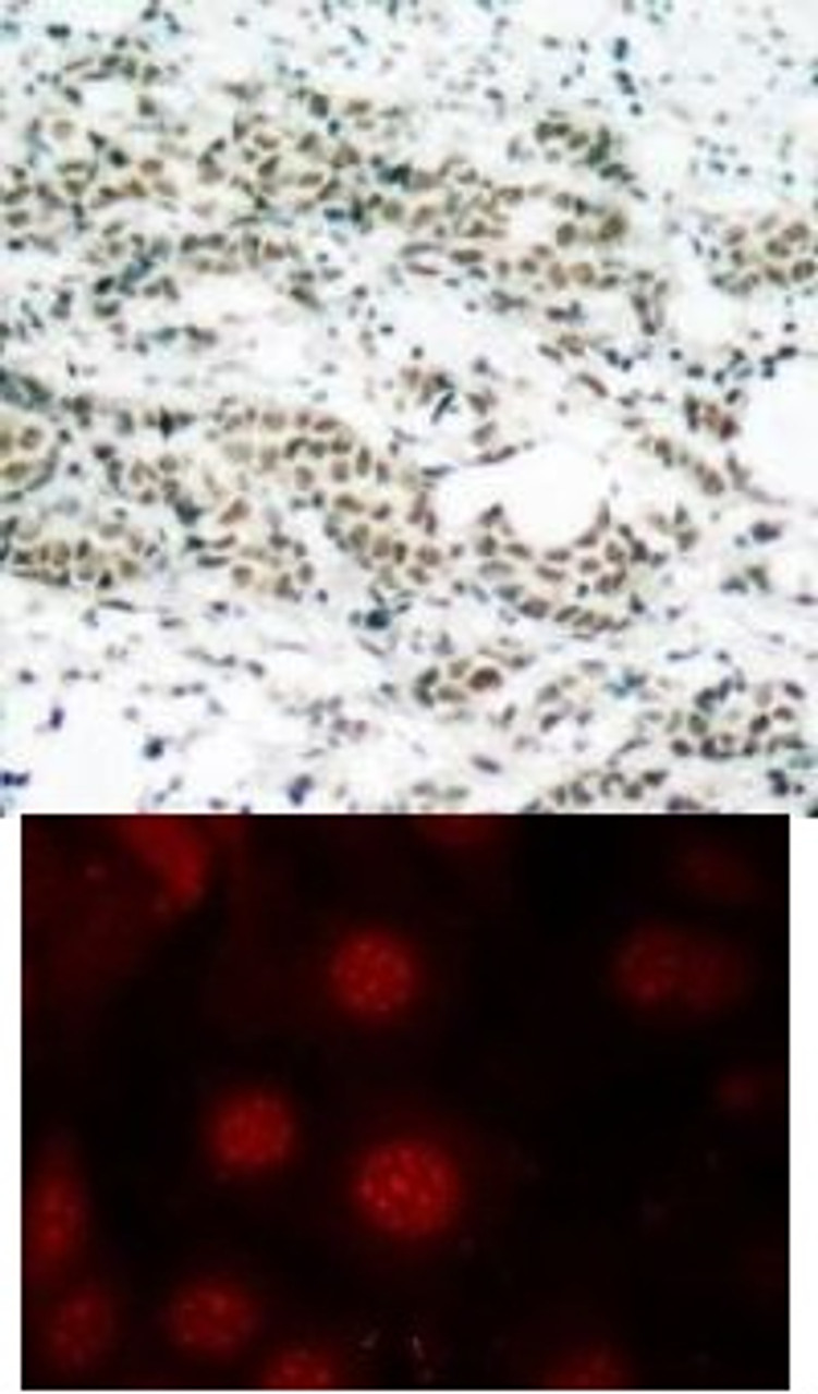 <b>Top Image:</b> Immunohistochemical analysis of paraffin-embedded human breast carcinoma tissue using AFX (Phospho-Ser197) .<b>Bottom Image:</b> Immunofluorescence staining of methanol-fixed MCF7 cells using AFX (Phospho-Ser197) .
