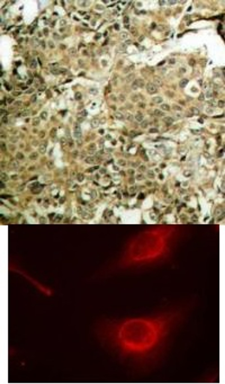 <b>Top Image:</b> Immunohistochemical analysis of paraffin-embedded human breast carcinoma tissue using cofilin (Phospho-Ser3) .<b>Bottom Image:</b> Immunofluorescence staining of methanol-fixed HeLa cells using cofilin (Phospho-Ser3) .