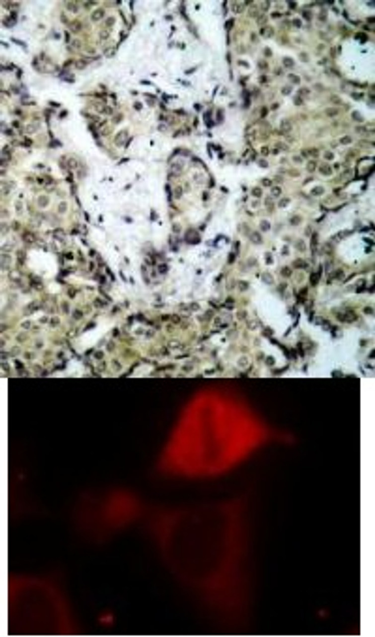 <b>Top Image:</b> Immunohistochemical analysis of paraffin-embedded human breast carcinoma tissue using MKK3 (Phospho-Ser189) .<b>Bottom Image:</b> Immunofluorescence staining of methanol-fixed HeLa cells using MKK3 (Phospho-Ser189) .