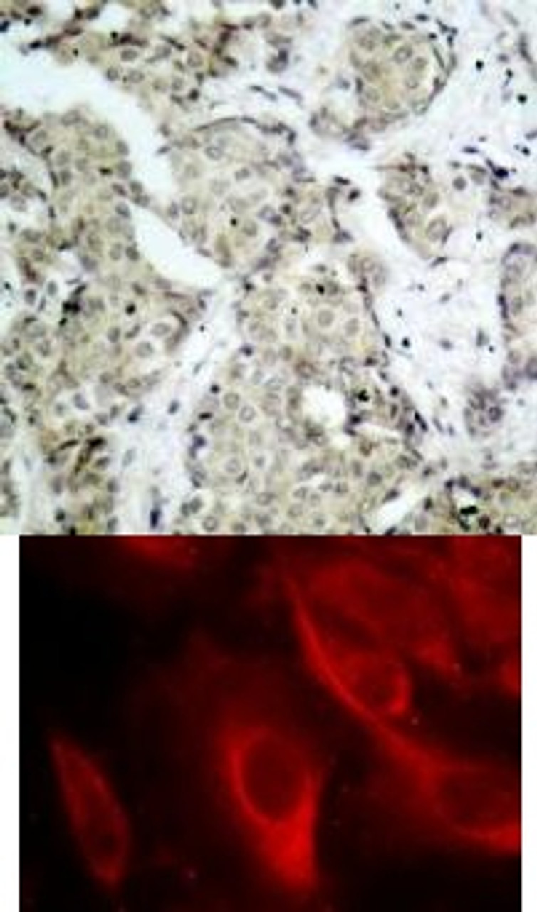 <b>Top Image:</b> Immunohistochemical analysis of paraffin- embedded human breast carcinoma tissue using MKK6 (Phospho-Ser207) .<b>Bottom Image:</b> Immunofluorescence staining of methanol-fixed HeLa cells showing cytoplasmic staining using MKK6 (Phospho-Ser207) .