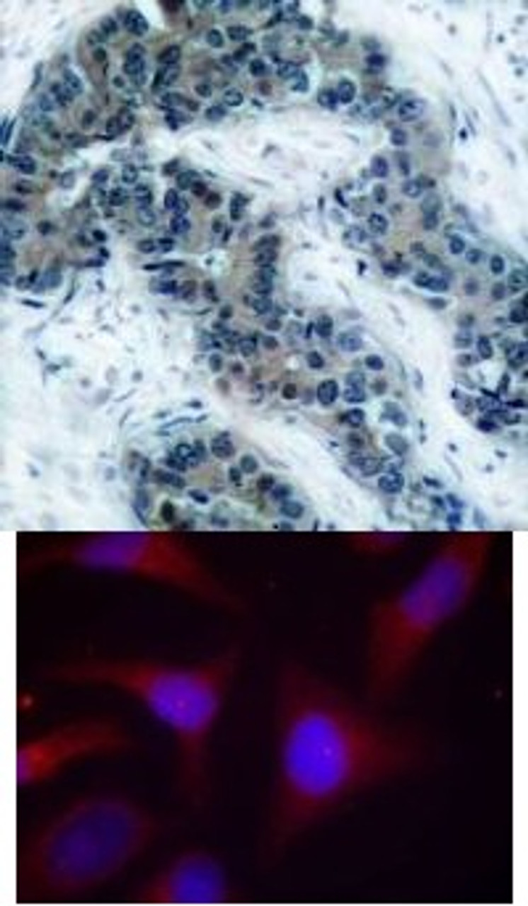<b>Top Image:</b> Immunohistochemical analysis of paraffin-embedded human breast carcinoma tissue using IkappaB-&#945; (Phospho-Ser32/Ser36) .<b>Bottom Image:</b> Immunofluorescence staining of methanol-fixed HeLa cells using IkappaB-&#945; (Phospho-Ser32/Ser36) .