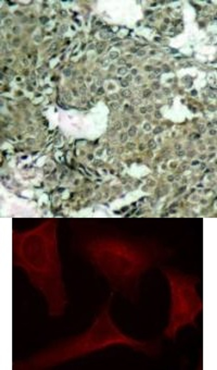 <b>Top Image:</b> Immunohistochemical analysis of paraffin-embedded human breast carcinoma tissue using MEK1 (Phospho-Ser221) .<b>Bottom Image:</b> Immunofluorescence staining of methanol-fixed HeLa cells using MEK1 (Phospho-Ser221) .