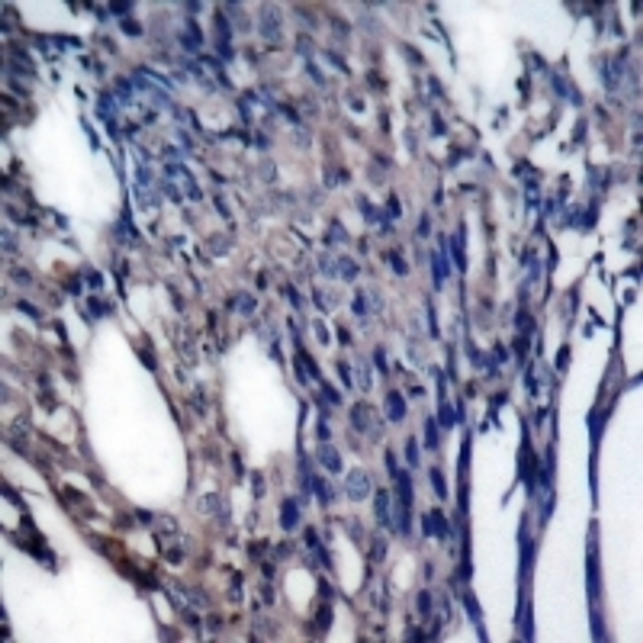 Immunohistochemical analysis of paraffin-embedded human breast carcinoma tissue using IkappaB-&#945; (phospho-Tyr42) .