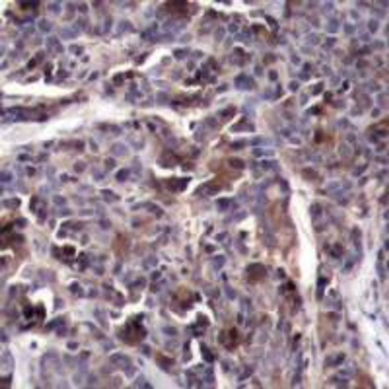 Immunohistochemical analysis of paraffin-embedded human breast carcinoma tissue using NF&#954;B-p65 (Phospho-Thr505) .
