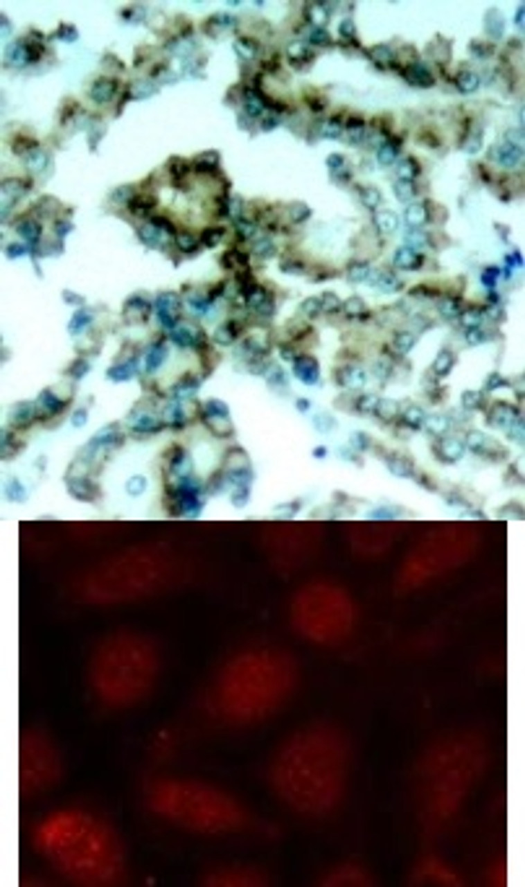 <b>Top Image:</b> Immunohistochemical analysis of paraffin-embedded human lung carcinoma tissue, using PKC&#946; (phospho-Thr641) .<b>Bottom Image:</b> Immunofluorescence staining of methanol-fixed MCF7 cells using PKC&#946; (phospho-Thr641) antibody (#11172, Red) .